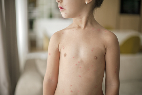 子どもの帯状疱疹の症状は、大人のそれとは違うのでしょうか。子どもの帯状疱疹の症状と特徴について紹介します。