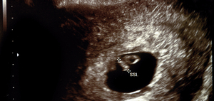 産婦人科医監修 胎嚢 たいのう の大きさの平均は 妊娠5週 6週 7週の目安は 週数別に解説 ままのて