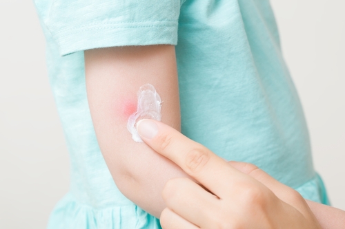 【小児科医監修】赤ちゃんの虫刺され！蚊やダニで腫れたら病院に行くべき？症状と虫の種類別の対処法、注意点、予防法は？